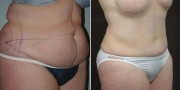 Dr. Kao Tummy Tuck (Abdominoplasty)