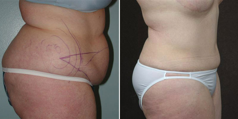 Dr. Kao Tummy Tuck (Abdominoplasty)