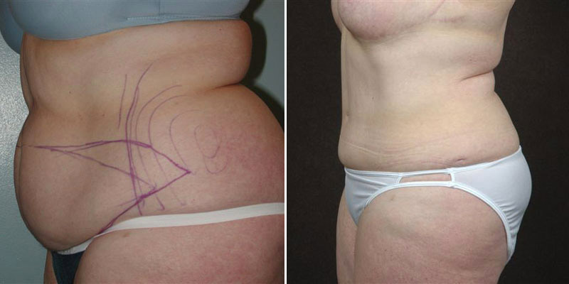 Dr. Kao Tummy Tuck (Abdominoplasty)