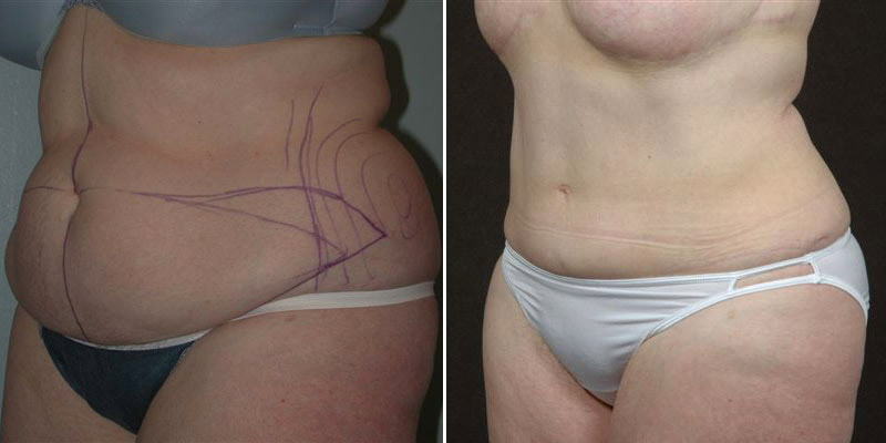 Dr. Kao Tummy Tuck (Abdominoplasty)