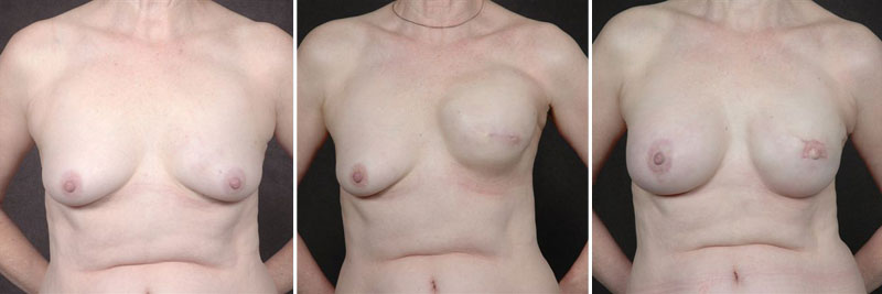 Dr. Kao Breast Reconstruction