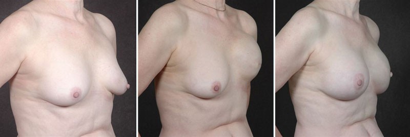 Dr. Kao Breast Reconstruction