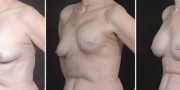 Dr. Kao Breast Reconstruction