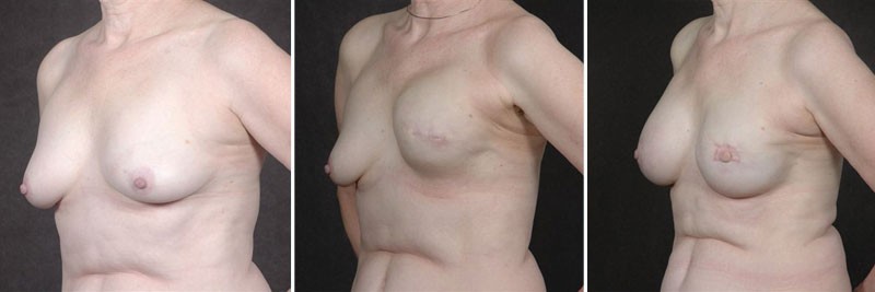 Dr. Kao Breast Reconstruction