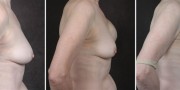 Dr. Kao Breast Reconstruction