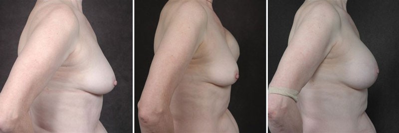 Dr. Kao Breast Reconstruction