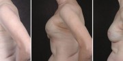 Dr. Kao Breast Reconstruction