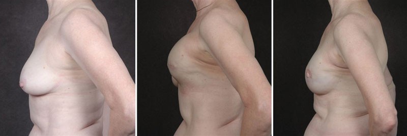 Dr. Kao Breast Reconstruction