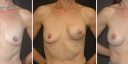 Dr. Kao Breast Reconstruction