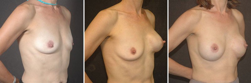 Dr. Kao Breast Reconstruction