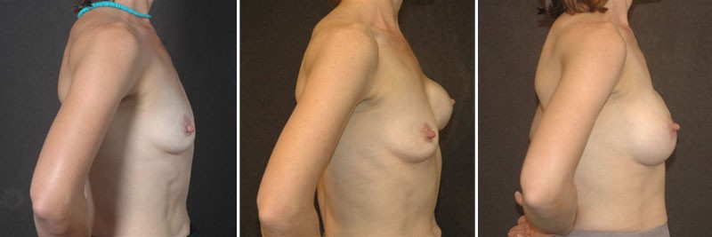 Dr. Kao Breast Reconstruction