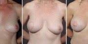 Dr. Kao Breast Reconstruction