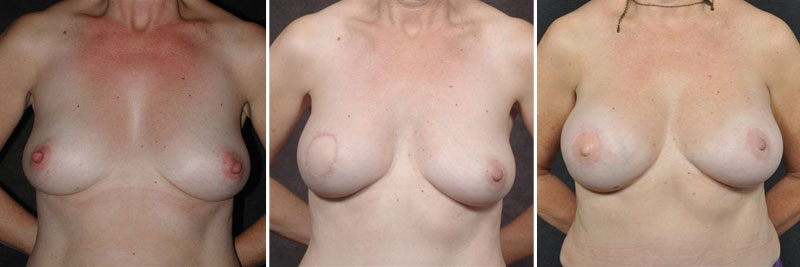 Dr. Kao Breast Reconstruction