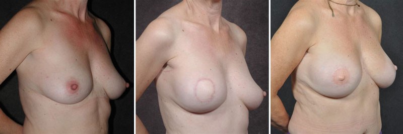 Dr. Kao Breast Reconstruction