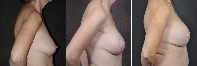 Dr. Kao Breast Reconstruction