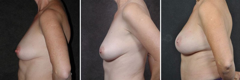 Dr. Kao Breast Reconstruction