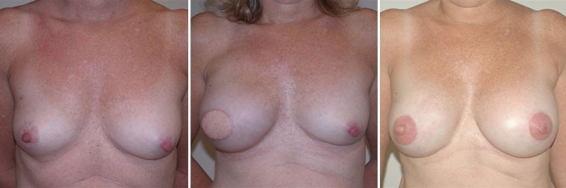 Dr. Kao Breast Reconstruction