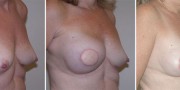 Dr. Kao Breast Reconstruction