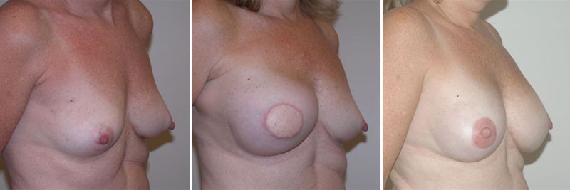 Dr. Kao Breast Reconstruction