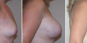 Dr. Kao Breast Reconstruction