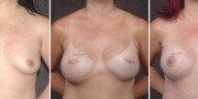 Dr. Kao Breast Reconstruction