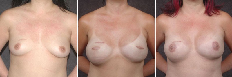 Dr. Kao Breast Reconstruction