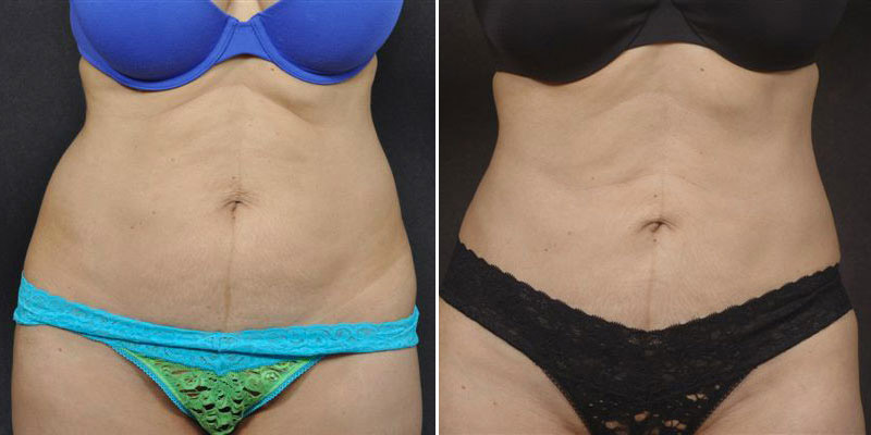 Dr. Kao Liposuction