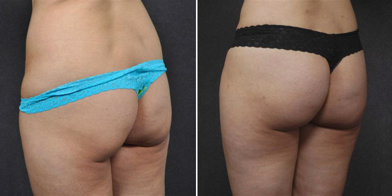 Dr. Kao Liposuction & Butt Augmentation