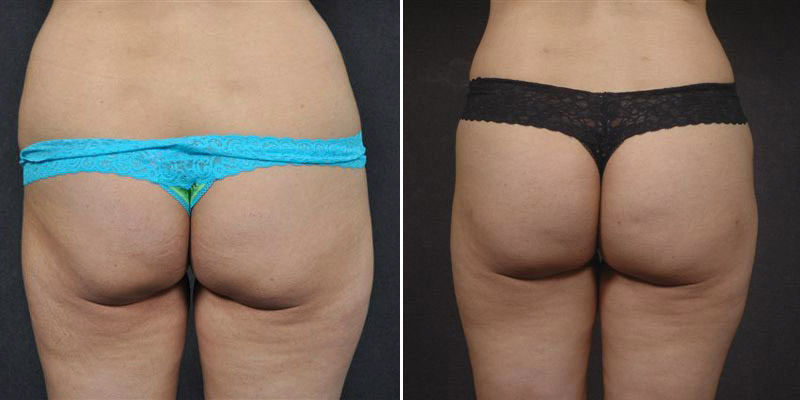 Dr. Kao Liposuction & Butt Augmentation