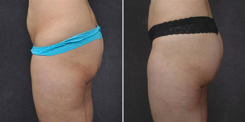 Dr. Kao Liposuction & Butt Augmentation