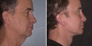 Dr. Kao Make Ponytail Facelift