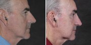 Dr. Kao - Men's Ponytail Facelift