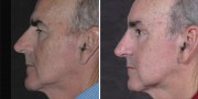 Dr. Kao - Men's Ponytail Facelift