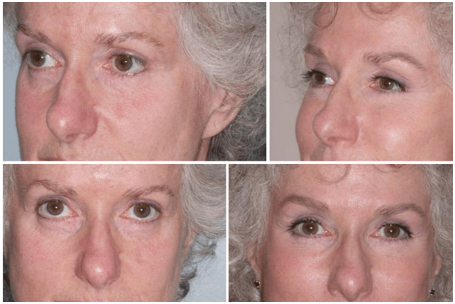 Dr. Kao - Contour Eyelift Before & After Photos