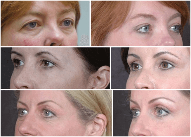 Dr. Kao - Contour Eyelift Before & After Photos