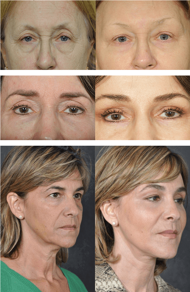 Dr. Kao - Contour Eyelift Before & After Photos