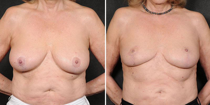 Dr. Kao Implant Removal with Breast Lift