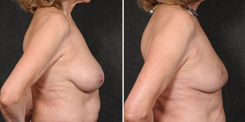 Dr. Kao Implant Removal with Breast Lift