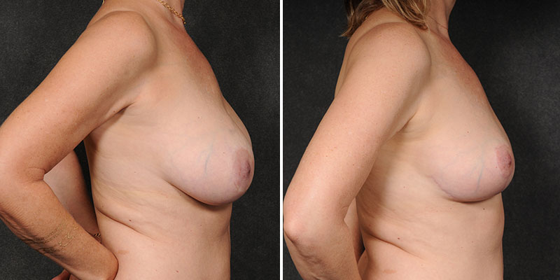 Dr. Kao Implant Removal with Breast Lift