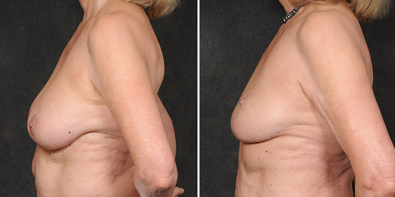 Dr. Kao Implant Removal with Breast Lift