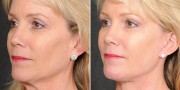 Dr. Kao Ponytail Facelift