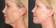 Dr. Kao Ponytail Facelift