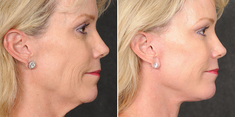 Dr. Kao Ponytail Facelift