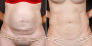 Abdominoplasty before and after