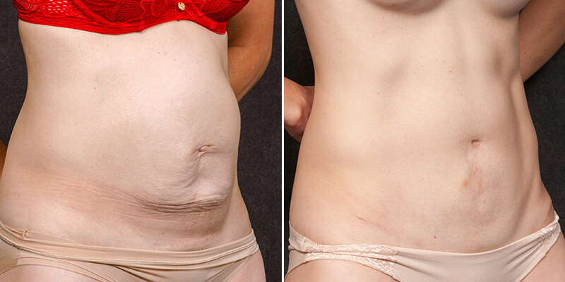 Abdominoplasty before and after