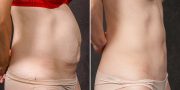 Abdominoplasty before and after