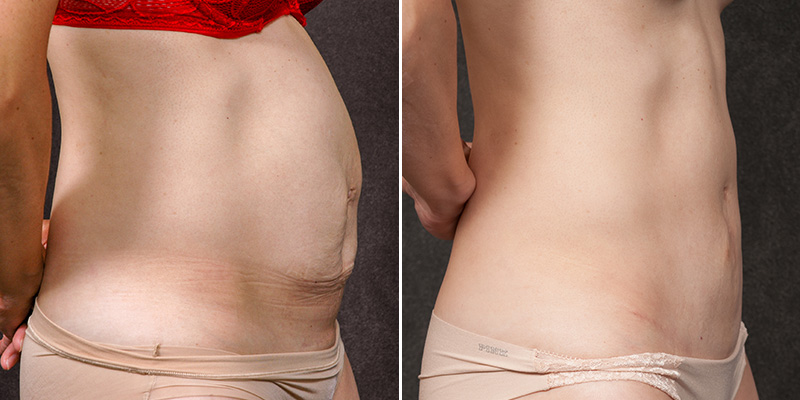 Abdominoplasty before and after