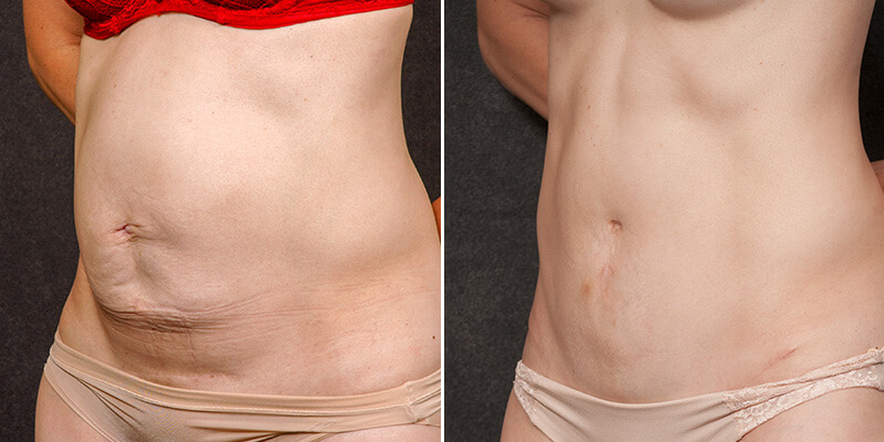 Abdominoplasty before and after
