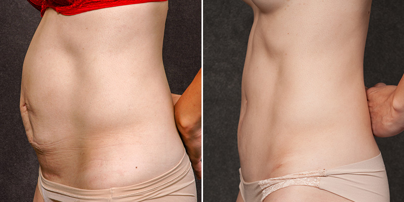 Abdominoplasty before and after