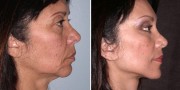 Dr. Kao Ponytail Facelift with Neck Lift